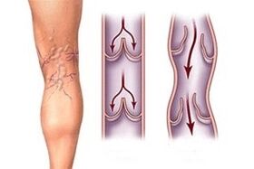 kraujo nutekėjimas iš varikozinių venų įvairiais ligos vystymosi etapais